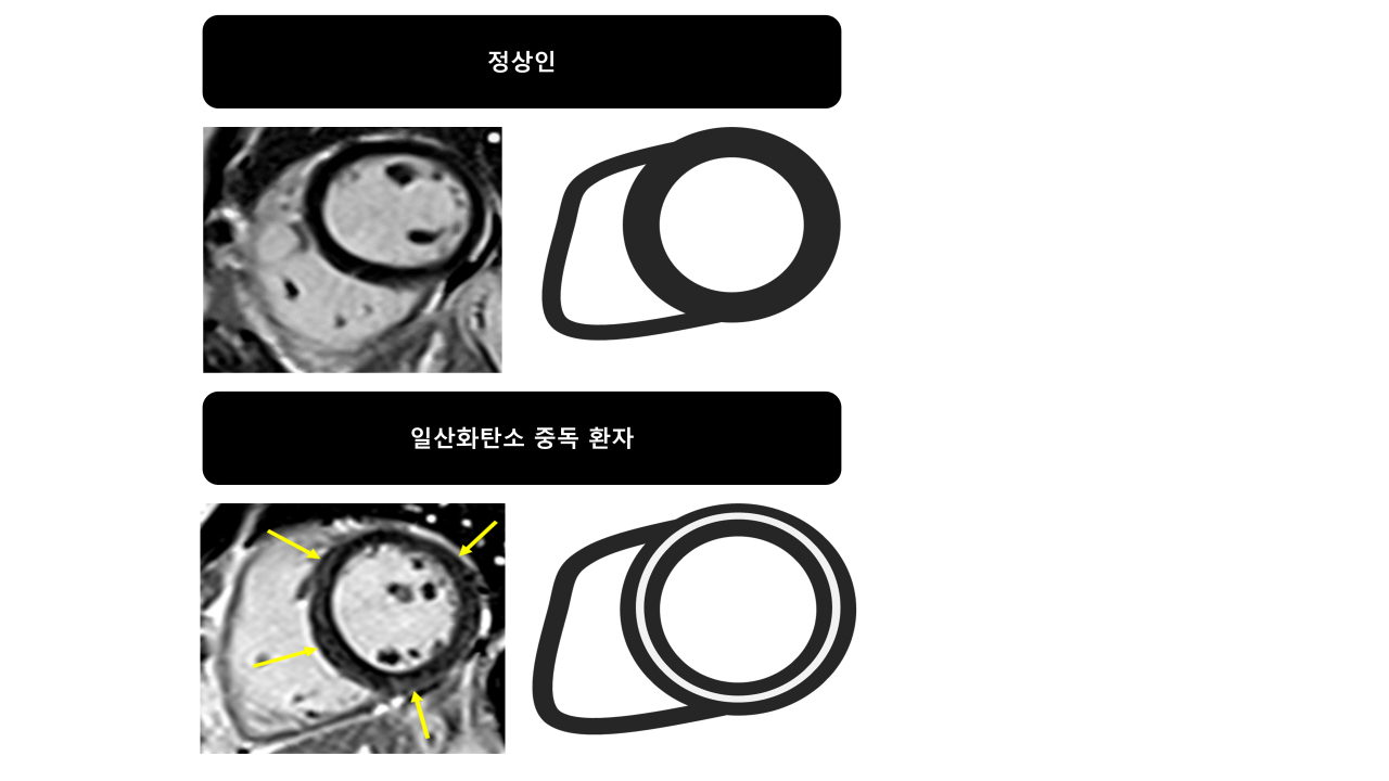 급성일산화탄소중독 환자에서 심장자기공명영상에 의해 발견된 심근손상. 총 104명 환자의 심장 MRI를 촬영한 결과 69%의 환자에서 심근의 미세손상이 관찰됐다. 손상패턴을 분석했을 때 104명 중 40%에서 심근의 중간벽 층에 비가역적인 섬유화(그림의 노란 화살표로 표시된 부분이 섬유화 된 부분) 소견을 보였다.[연세대학교 제공]