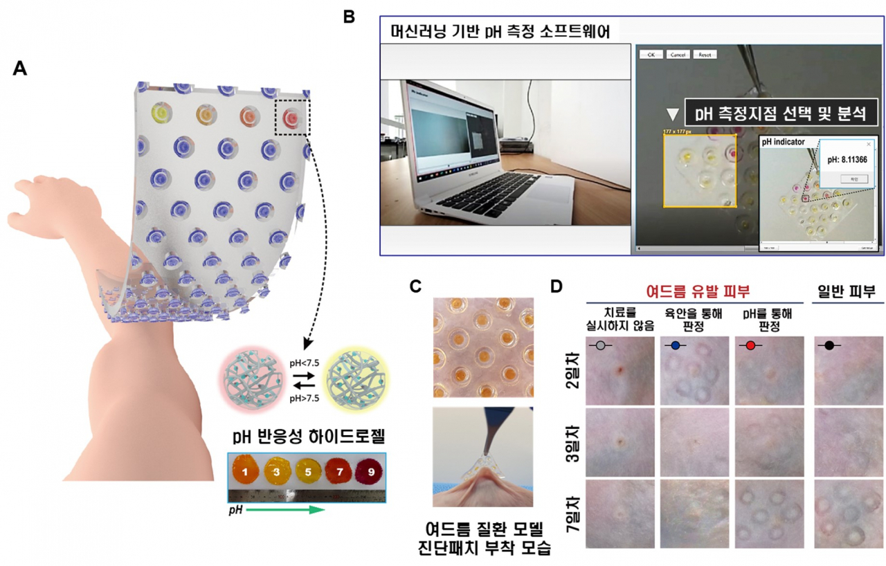 피부 모니터링 패치의 점착성능 분석과 수분 포집 거동(A) 피부 모니터링 패치를 피부에 부착한 뒤 탈착하는 모습으로, 점착성능은 사람의 피부와 유사한 돼지피부를 이용해 건조하거나 젖은 표면에서의 점착성능을 측정하였다. (B) 그 결과 점착 컵을 가진 물방개모사 패턴의 패치가 패턴이 없는 패치에 비해 우수한 점착성능을 가졌다. (C) 체액 포집을 위한 하이드로젤을 점착 컵에 담지한 모습을 나타낸 개념도이다. (D) 점착 컵 내부에 삽입된 하이드로젤에 의해 수분(체액)이 컵 내부로 포집될 수 있는 것을 공초점 현미경을 통해 확인하였다.[성균관대 제공]