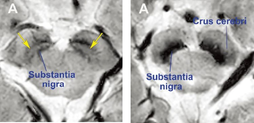 정상 모양의 흑질(좌), 파킨슨병 환자의 흑질(우) MRI 영상(흑질(substantia nigra)의 검정 부위 사이에 좌측 그림의 노란색 화살표가 가리키는 밝은 부분이 있으면 정상이고, 우측 그림처럼 검정색으로 메워지면 도파민신경세포가 소실된 환자이다.