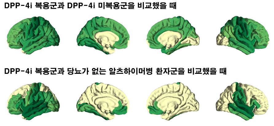 아밀로이드베타 단백질 축적 정도 비교:　△DPP-4 억제제를 복용한 당뇨 알츠하이머병 환자가 복용하지 않은 당뇨 알츠하이머병 환자에 비해 아밀로이드베타 단백질 축적 정도가 경미했다.(초록색 부분). △DPP-4 억제제를 복용한 당뇨 알츠하이머병 환자가 당뇨가 없는 알츠하이머병 환자에 비해서도 아밀로이드베타 단백질 축적 정도가 경미했다.(초록색 부분).