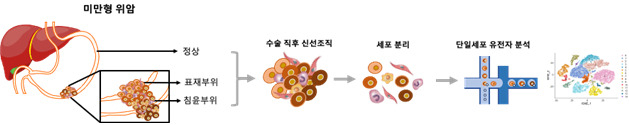 미만형 위암 조직 내 암세포를 비롯한 종양미세환경을 분석하기 위해 수술 직 후 신선 시료를 확보하여 세포를 분리한 후 단일세포유전자 분석을 시행했다. 단일세포유전자분석에서 각 세포들의 위치정보가 소실되는 한계점을 극복하기 위하여 미만형 위암의 진행에 따른 조직을 각각 확보했다.[아주대학교 제공]