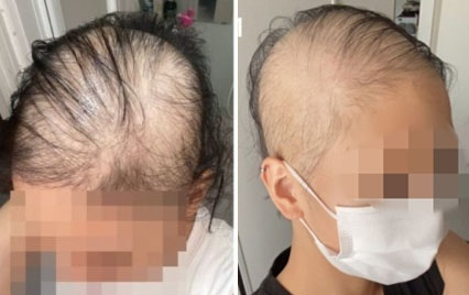 일본의 한 20대 여성이 지난 6월말 모더나 백신 1차 접종을 한 뒤 탈모가 시작됐다며 공개한 사진. [블로그 캡처]