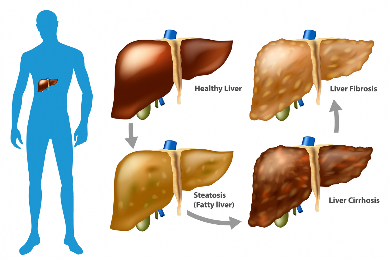 간 질환이 악화되는 단계. 건강한 간이 지방간(fatty liver)&rarr;간경화(liver cirrhosis)&rarr;간 섬유화(Liver Fibrosis )로 진행되고 있다. [123rf]