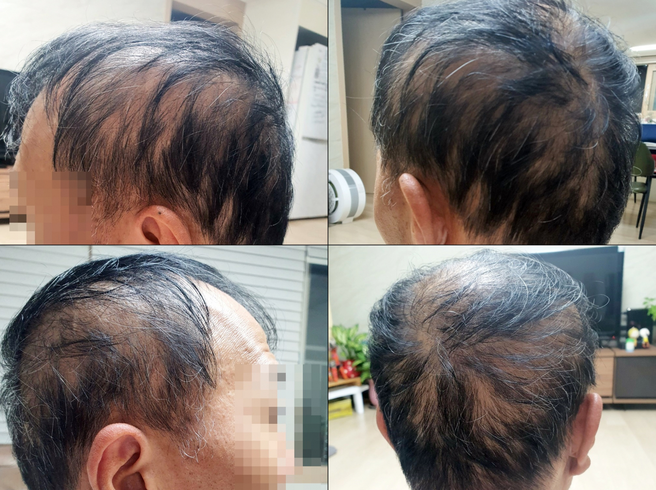 모더나 백신 2차 접종 이후 심각한 탈모 증상을 호소한 50대 남성 김모씨. [연합]
