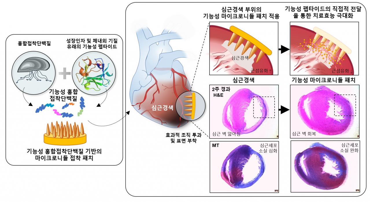 심근경색 치료용 기능성 마이크로니들 접착 패치 모식도.[포스텍 제공]