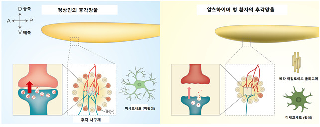 알츠하이머 치매환자의 후각망울 내 사구체 변화 개념도.[DGIST 제공]