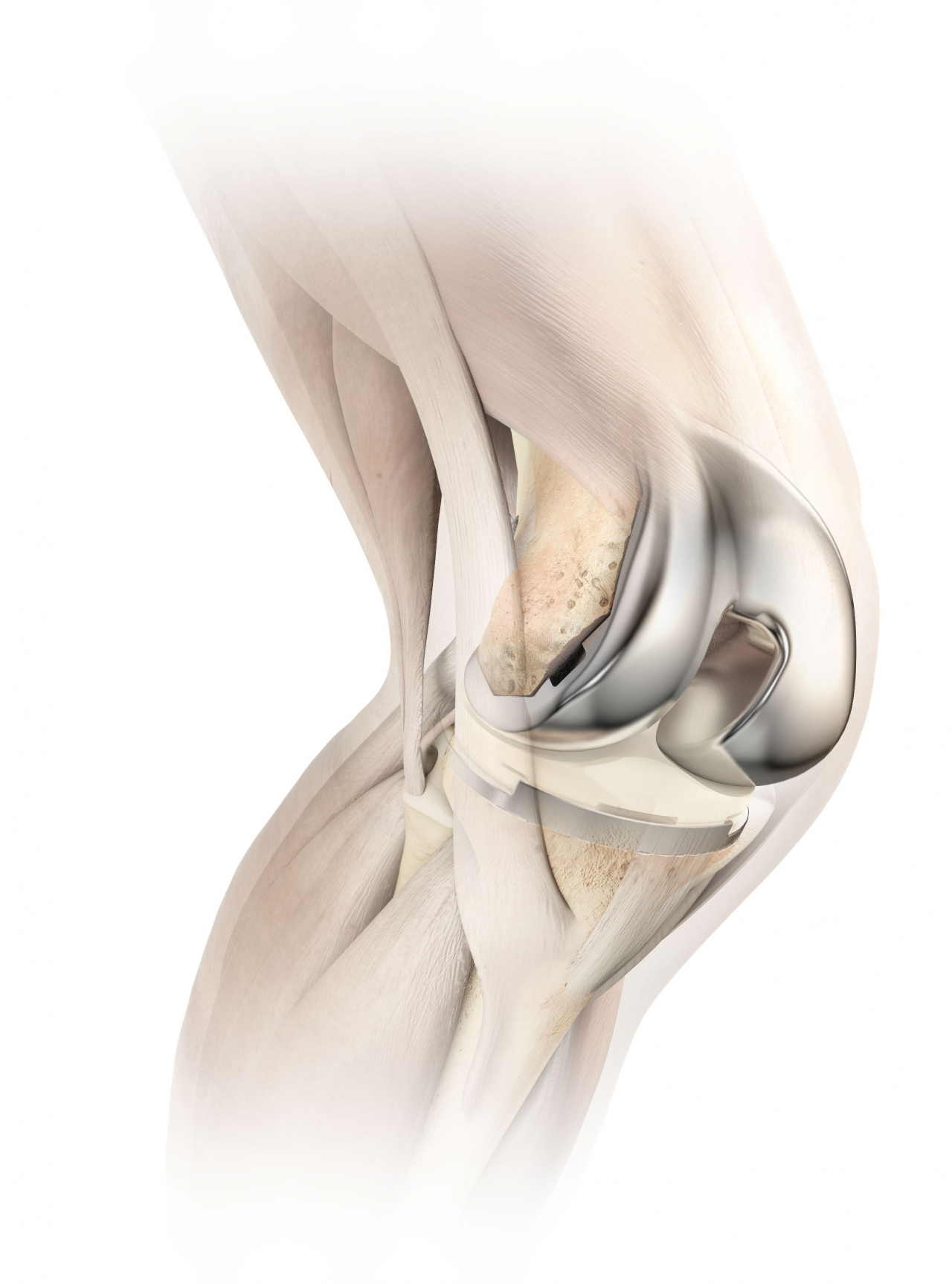 연세사랑병원이 최근 도입한 3세대 디자인 인공관절 'Attune Knee System'