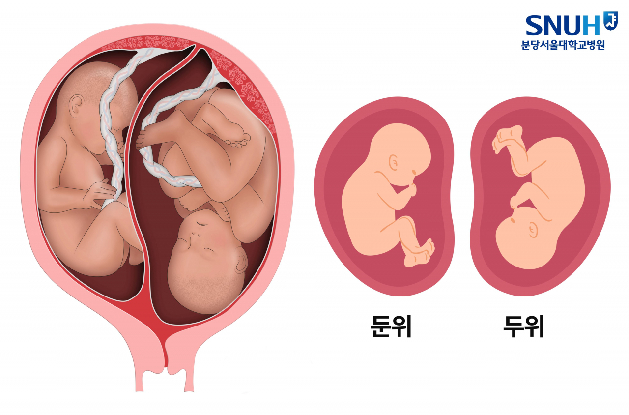 자궁속 태아자세[분당서울대병원 제공]