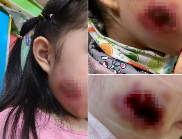 지난 12월 9일 수포가 처음 올라왔을 당시 모습(왼쪽)과 16일 상태가 악화된 모습. [온라인 커뮤니티 갈무리]