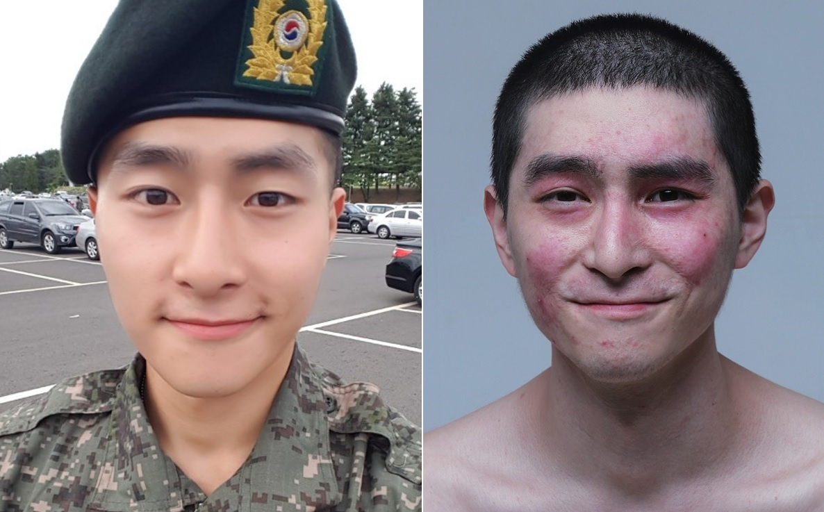 K-9 자주포 폭발 사고 생존자 이찬호(28) 씨의 사고 전(왼쪽) 모습과 사고 후 모습. 그는 2019년 포토에세이 '괜찮아, 돌아갈수 없어도'를 내고 "화상 흉터를 숨기고 살 이유를 모르겠더라"고 했다. [이찬호 씨 제공]