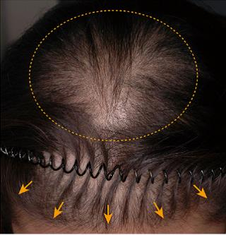 여성형 탈모증 앞머리 헤어 라인은 유지되나(화살표), 두정부의 모발 밀도가 떨어지고 가늘어짐