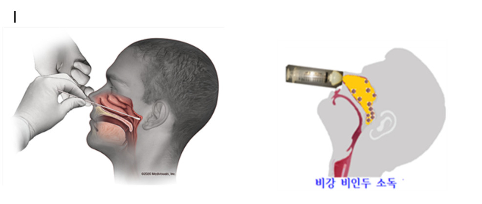 비강 세정기술 모식도.[김대황 박사 제공]