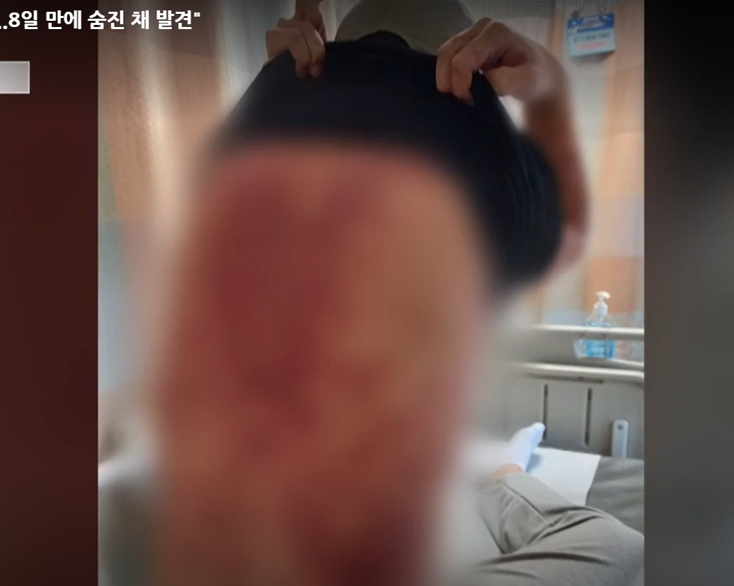 부대 복귀 8일 만에 숨진 현역 군인이 생전에 백신 접종 후 온 몸에 두드러기가 난 모습을 보여주고 있다. [YTN영상 캡처]