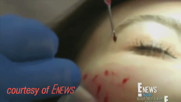 세계적인 모델 겸 배우 킴 카다시안이 일명 ‘뱀파이어 페이셜(Vampire Facial)’ 시술을 받고 있는 모습. [유튜브 'Beauty and your beast' 채널 캡처]