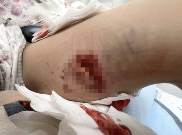 목줄 없이 풀어놓고 기르는 풍산개 5마리에게 7세 아이가 물려 큰 부상을 입은 사건. [국민동의청원 홈페이지]