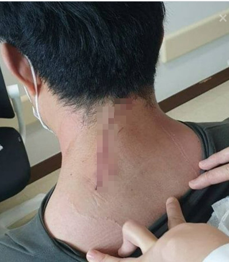 70대 남성이 휘두른 낫에 목 뒤를 10cm 가량 꿰맨 의사.