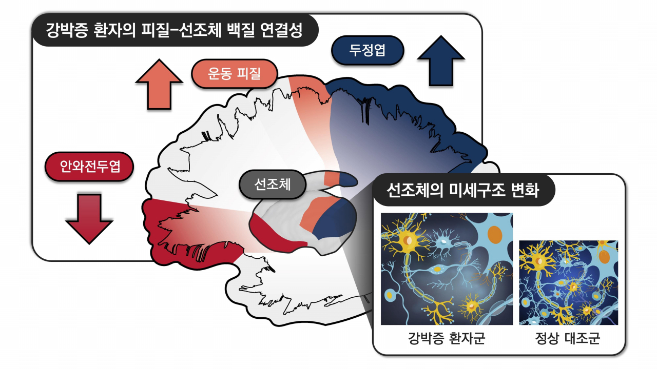 강박증 환자에서 관찰한 대뇌 피질-선조체 회로의 변화. 안와전두엽과의 연결성은 감소한 반면, 운동 피질과 두정엽과의 연결성은 증가해 있어, 대뇌피질-선조체 회로의 균형이 깨져있는 것으로 나타났다. 또한 연구팀은 강박증 환자에서 선조체 영역의 미세구조도 손상되었다는 것을 확인했다.