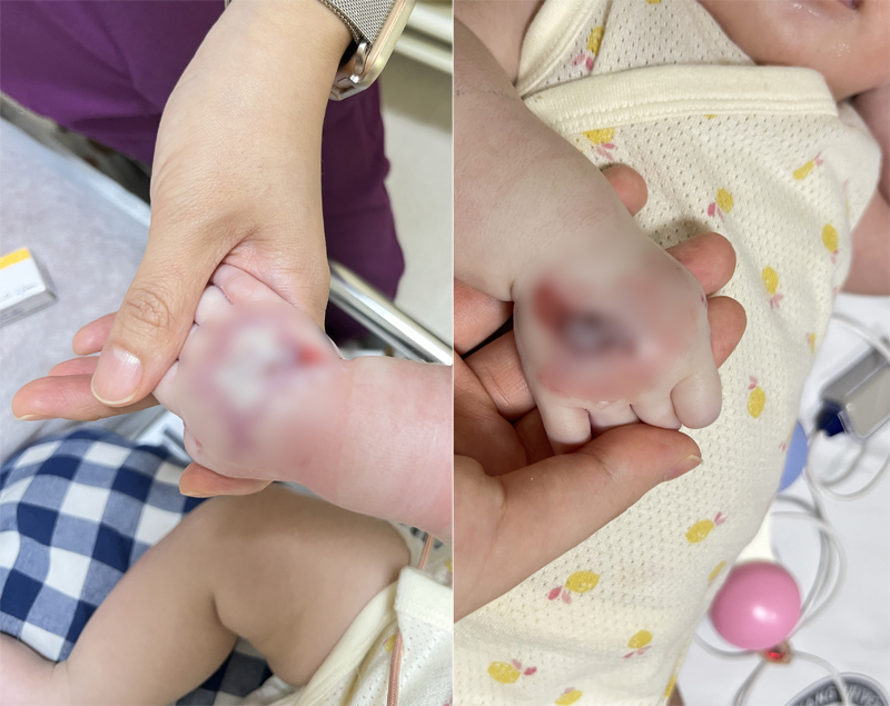 링거를 맞은 아기의 손등에 붙어있던 테이프를 제거한 직후(왼쪽)와 연고를 바르고 처치한 이후 모습. [온라인 커뮤니티 캡처]