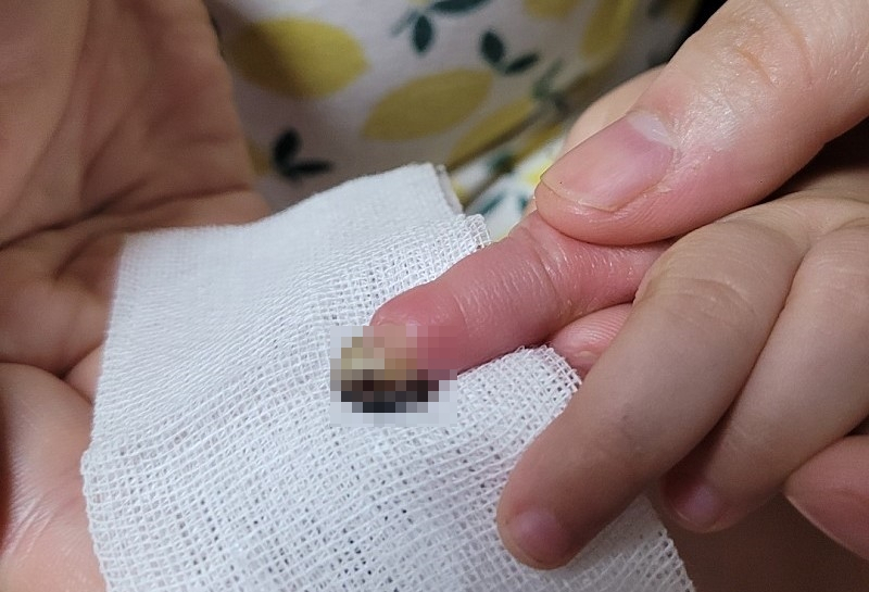 유모차 이용 중 갑자기 접혀 17개월된 아기 손가락이 절단돼 절단봉합수술을 받았지만 괴사가 온 아이의 손가락. [출처=온라인 커뮤니티 캡처]