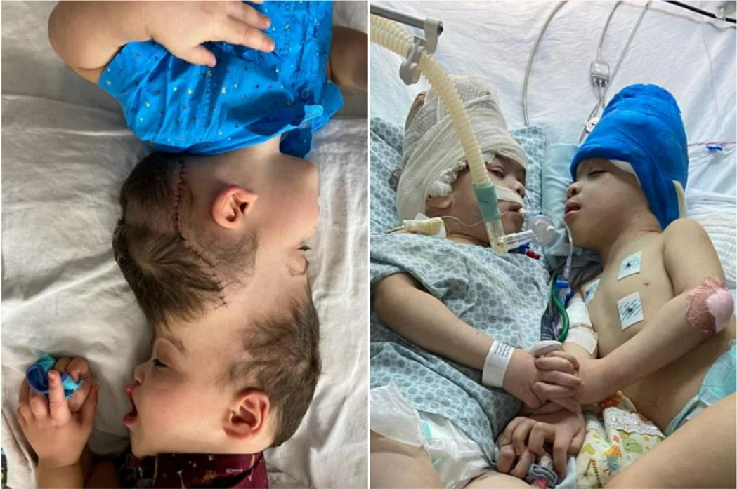 샴쌍둥이 베르나르도와 아서 리마의 수술 전 모습(왼쪽). 1일(현지시간) 브라질 리우데자네이루 파울로 니마이어 주립 뇌 연구소 병원(IECPN)에서 머리와 뇌 분리 수술을 진행한 모습(우측). [AFP][연합]