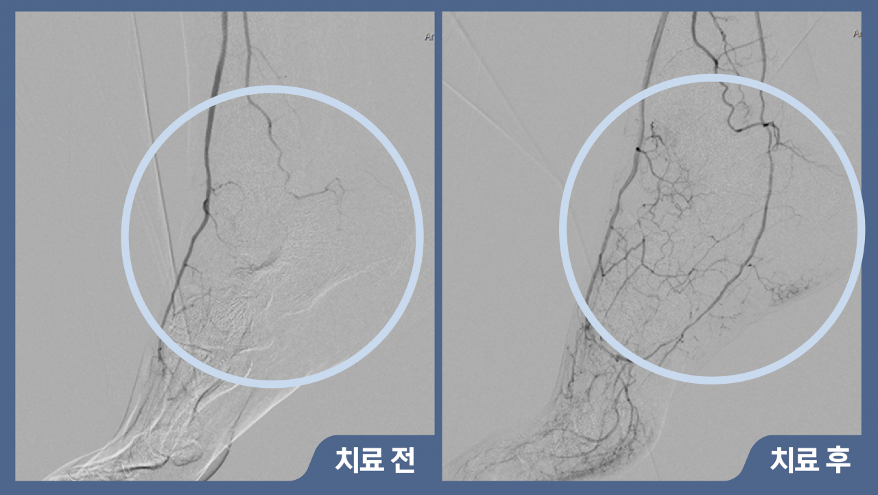 혈관개통술 전과 후