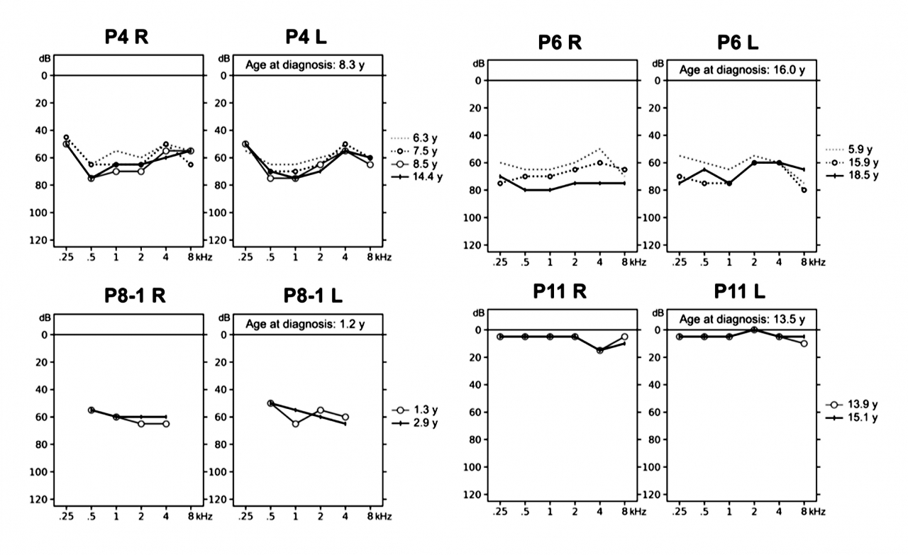 [Figure1] CoQ6 유전자 돌연변이 환자의 청력도 변화. CoQ10 투여에 따른 장기간 청력검사가 가능했던 환자의 절반 가량에서 청력 보존과 난청 회복 소견을 보였다.