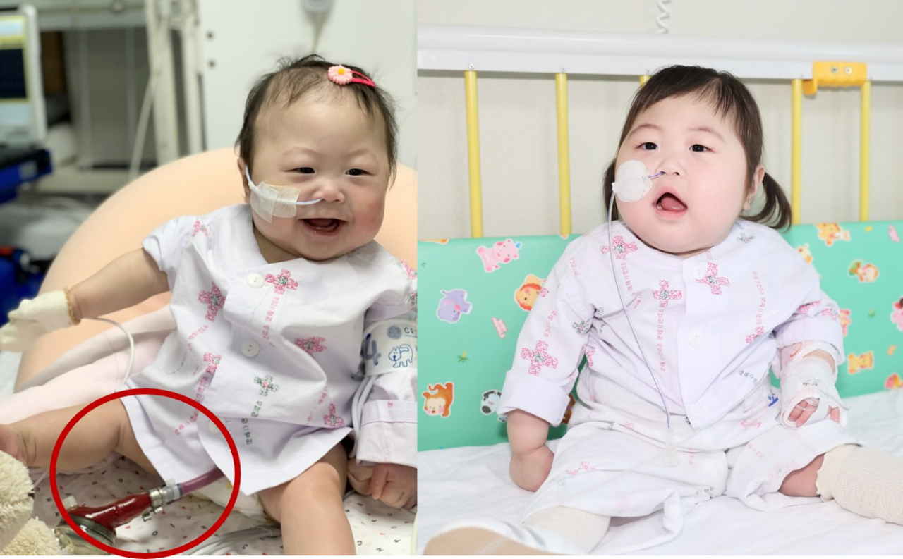 육수진 환아가 VAD(심실보조장치)를 달고 있는 모습(왼쪽)과 심장이식 수술 후 퇴원을 앞둔 모습(오른쪽). [세브란스병원 제공]