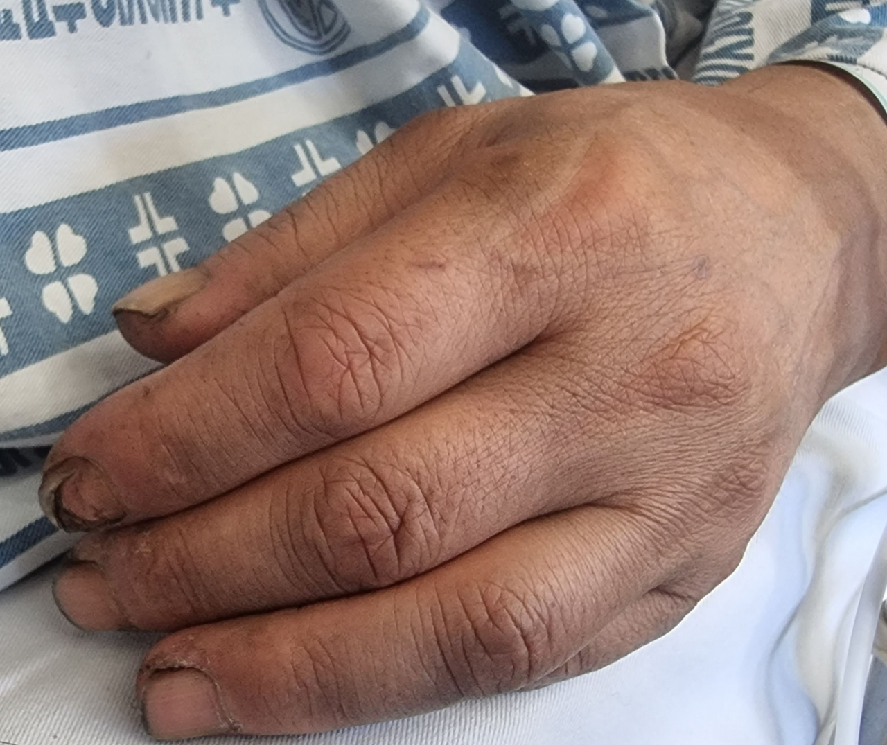 경북 붕화군 아연 채굴 광산 매몰 사고로 고립됐다가 열흘째인 4일 밤 극적으로 구조돼 5일부터 병원에서 회복 중인 선산부(작업 반장) 박정하(62)씨의 손끝이 갈라져 있다. [연합]