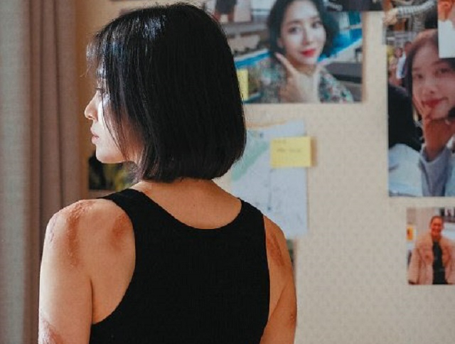 학폭으로 화상을 입은 극중 주인공 문동은(송혜교)의 몸. [넷플릭스]