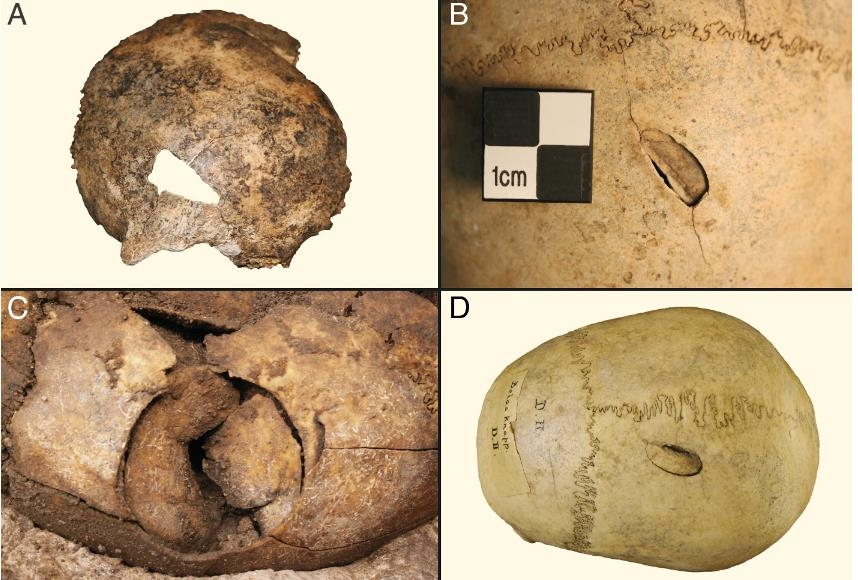 두개골에 난 전쟁과 폭력의 상처. [Fibiger, et. al. /PNAS 제공] [연합]
