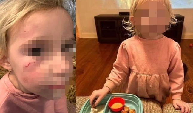 매건의 딸이 수탉 '헤이헤이'의 공격을 받아 생긴 상처(왼쪽). 치킨 너깃을 쥐고 있는 매건의 딸(오른쪽). [매건 슈미트 페이스북]