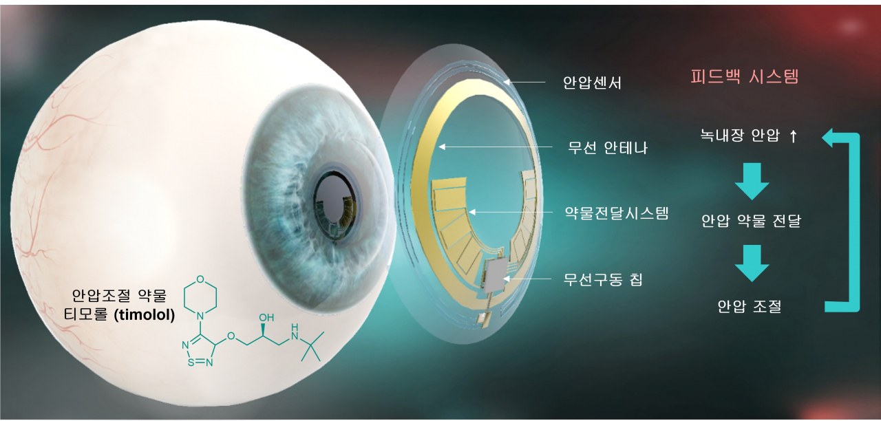 녹내장 환자의 안압 모니터링 및 안압 조절 약물 전달 피드백 시스템에 대한 모식도. [포스텍 제공]