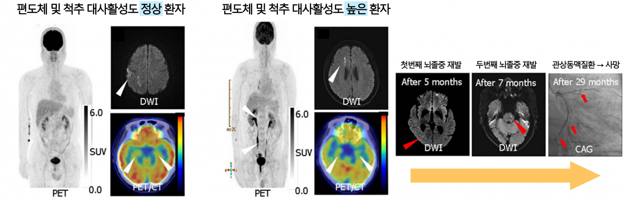 예후가 서로 다른 급성 뇌졸중 환자의 양전자 단층 촬영 검사 결과. 편도체 및 척추에서 대사활동이 활성화된 환자(오른쪽)는 퇴원 후 뇌졸중이 2차례 재발하여 결국 관상동맥질환으로 사망했다. 반면, 대사활동이 정상 수준이었던 환자(왼쪽)은 재발 없이 안정적인 예후를 보였다.