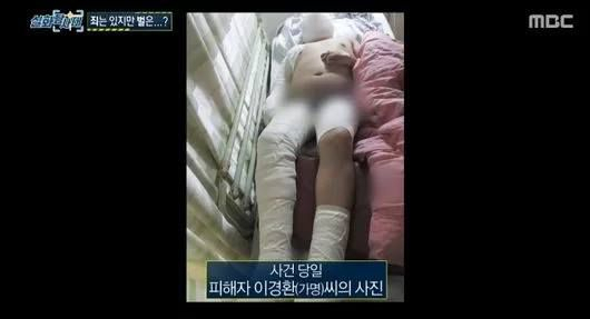 '생일 이벤트' 명목으로 피해자가 집단 폭력을 당해 전신에 화상을 입은 직후 모습. [MBC '실화탐사대']
