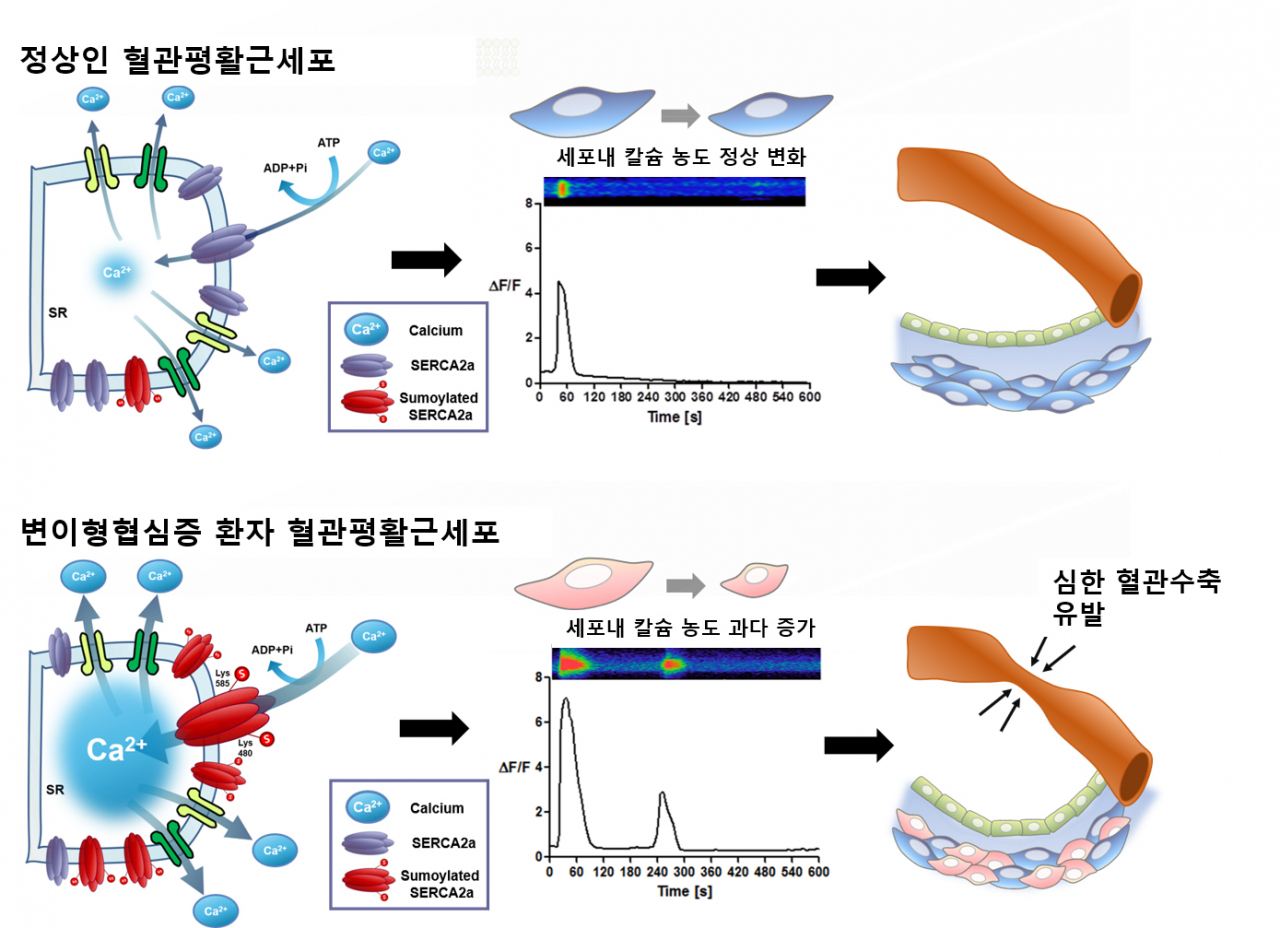 혈관 평활근세포의 정상 수축기전(위) 및 변이형 협심증 환자의 과도한 수축기전(아래) (위 패널) 정상적인 평활근세포- 칼슘 통로인 서카2 단백질이 소량만 존재- 소량의 칼슘이 소포체로 들어간 후, 세포질로 나오면서 1회의 탈분극 자극 유발&rarr; 적당한 수축 발생 (아래 패널) 변이형 협심증 평활근세포- 칼슘 통로인 서카2 단백질이 붕괴되지 않고 누적- 대량의 칼슘이 소포체로 들어간 후, 세포질로 쏟아져 나오면서 탈분극 자극이 강하게 되풀이됨&rarr; 과도한 수축 발생, 변이형 협심증 증세 유발