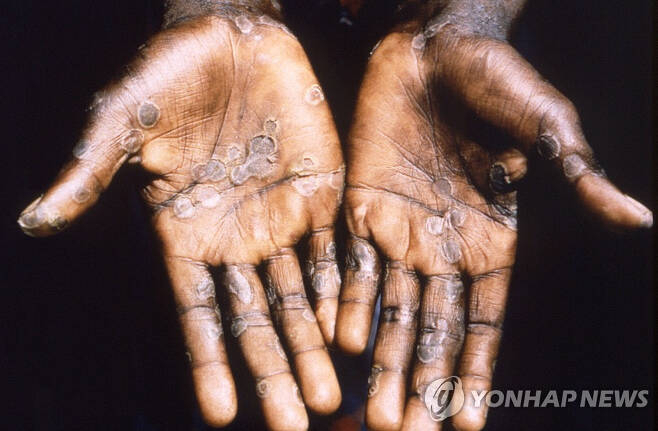 엠폭스 발생 지역에서 3주 이내 성접촉력이 있으면서 서혜부(사타구니) 림프절 비대가 동반되고 성기 및 항문 부위에 수포성 발진이 발생하는 경우는 반드시 엠폭스를 의심해야 한다. 〈연합〉