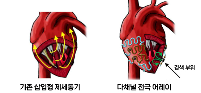 삽입형 제세동기와 다채널 전극어레이 구조.[IBS 제공]