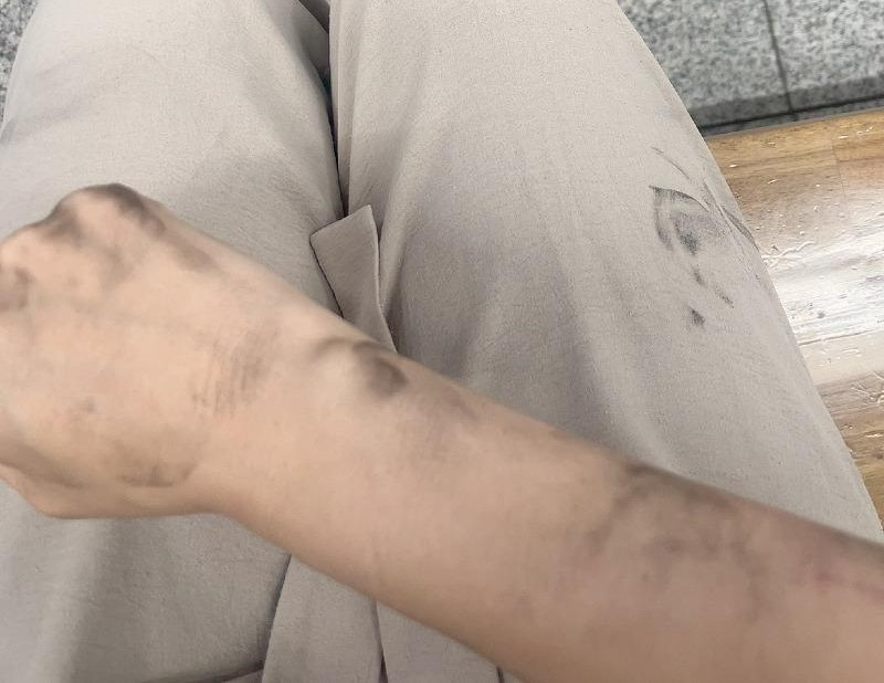 A씨가 지하철 9호선 전동차 안에서 쓰러진 뒤 병원에서 의식을 차린 뒤 찍은 자신의 팔뚝 사진. [보배드림 갈무리]