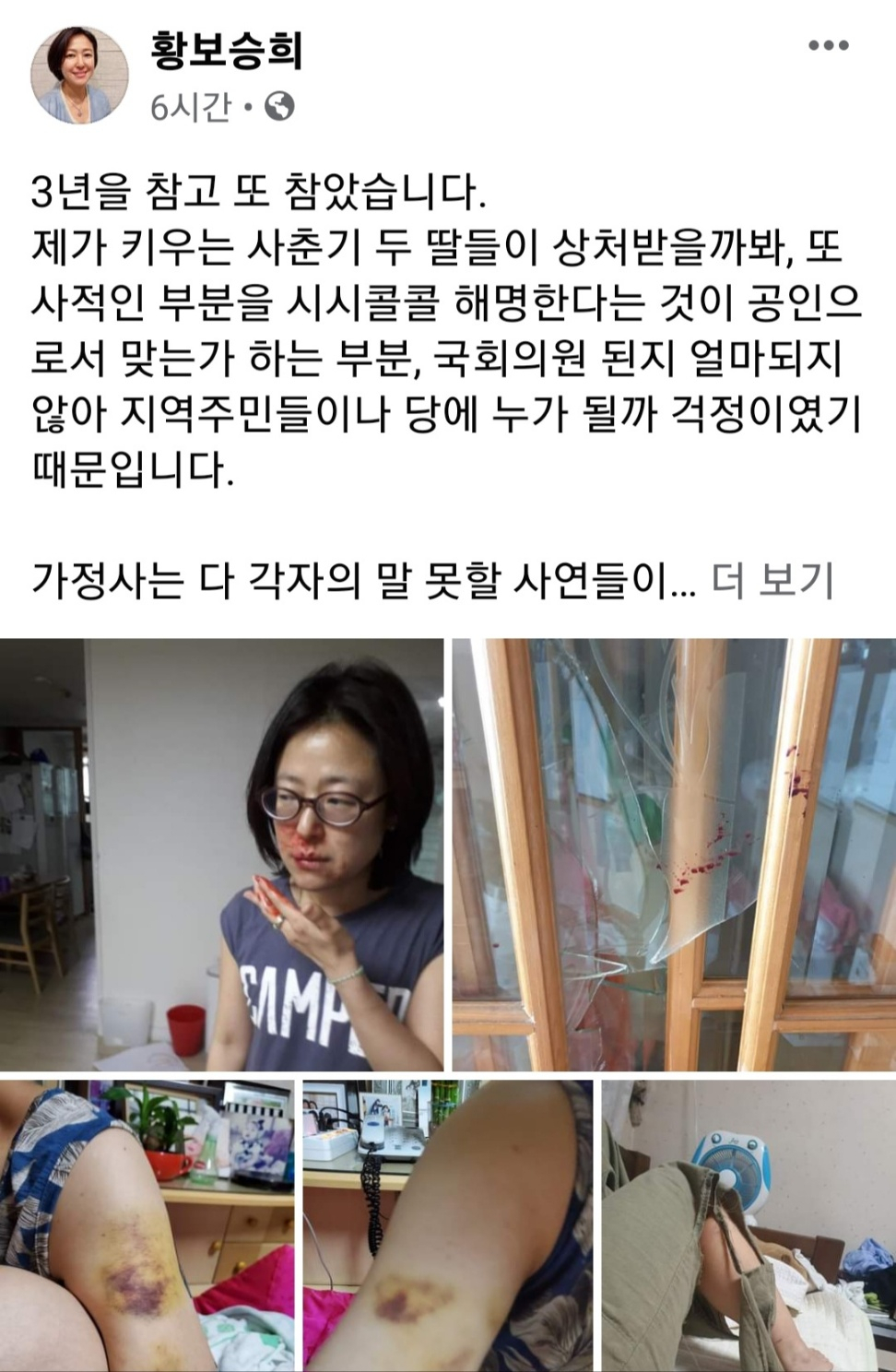 황보승희 의원이 15일 자신의 페이스북에 올린 게시글과 구타 피해사진. [사진=황보승희 의원 페이스북 화면캡처]