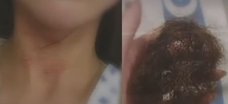 피해 여성 몸에 남은 상처(왼쪽)과 빠진 머리카락(오른쪽). [SBS 보도화면]
