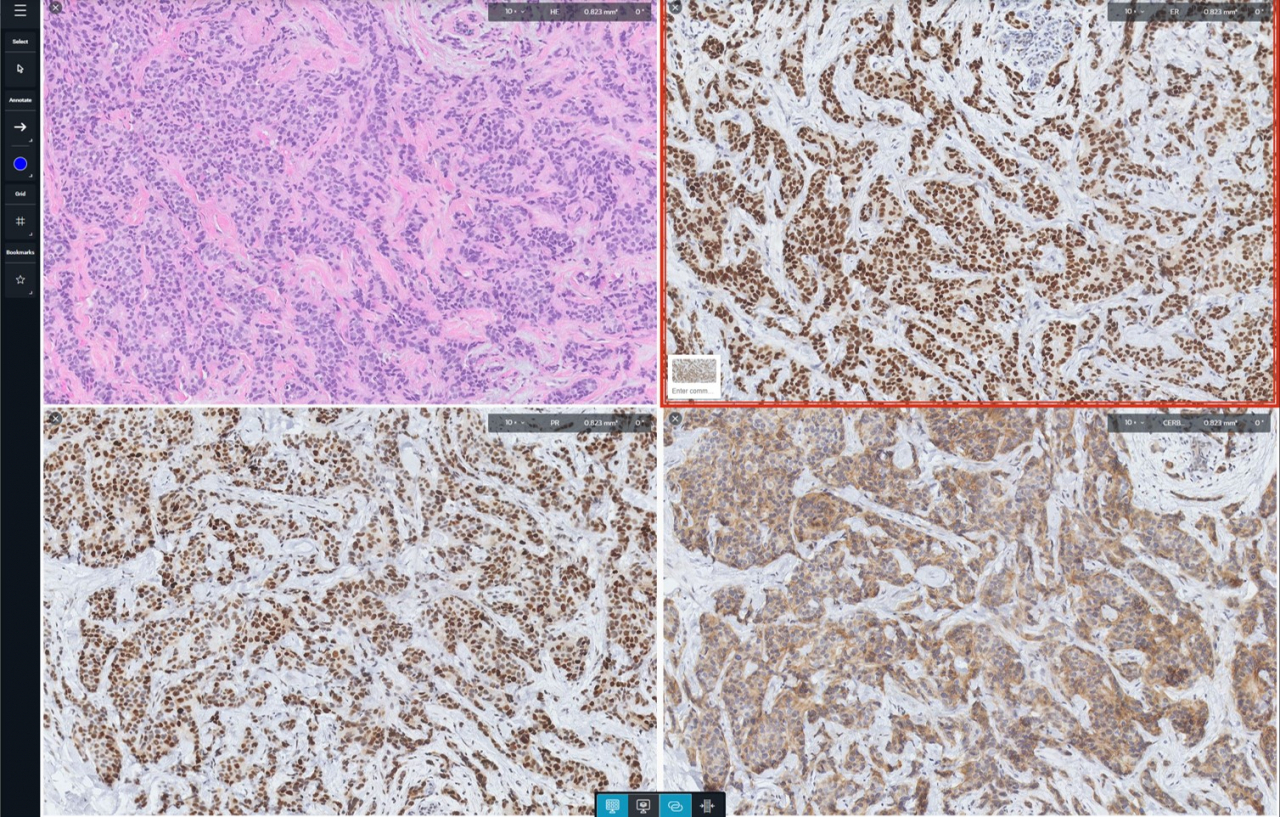 A screen shows whole slide images of four different levels of a single tissue specimen cut in various depths, projected on to a screen for analysis. (Singapore General Hospital)
