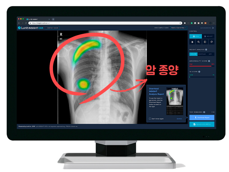 루닛 인사이트CXR. 빨간색 원 안에 형광색으로 표시된 부분이 종양 덩어리다. [루닛 제공]
