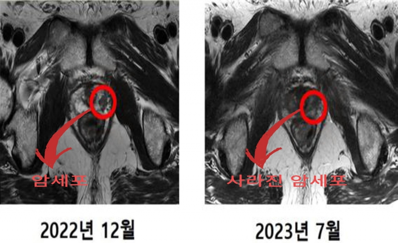 첫 중입자치료 환자 MRI 비교 사진. 지난해 12월 사진(왼쪽) 표시 안에 있던 암세포가 올해 7월 사진에서는 보이지 않는다. [연세의료원 제공]
