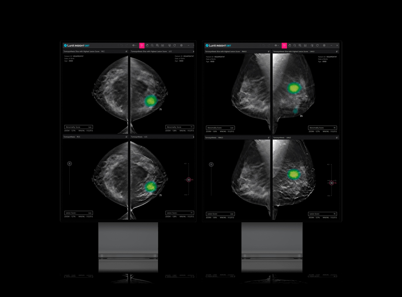 루닛 인사이트 DBT[루닛 제공]