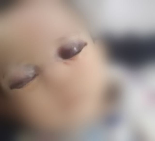 경북 구미에서 양쪽 눈에 멍이 든 상태로 병원에 옮겨져 치료중인 생후 6개월 아기 [유튜브 엄태웅TV 캡처]