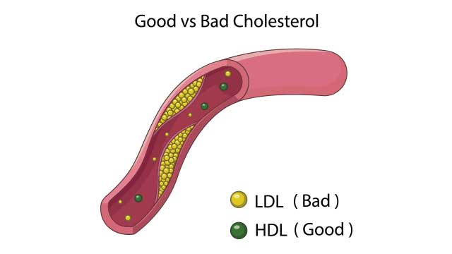 HDL 콜레스테롤과 LDL 콜레스테롤.[게티이미지뱅크]