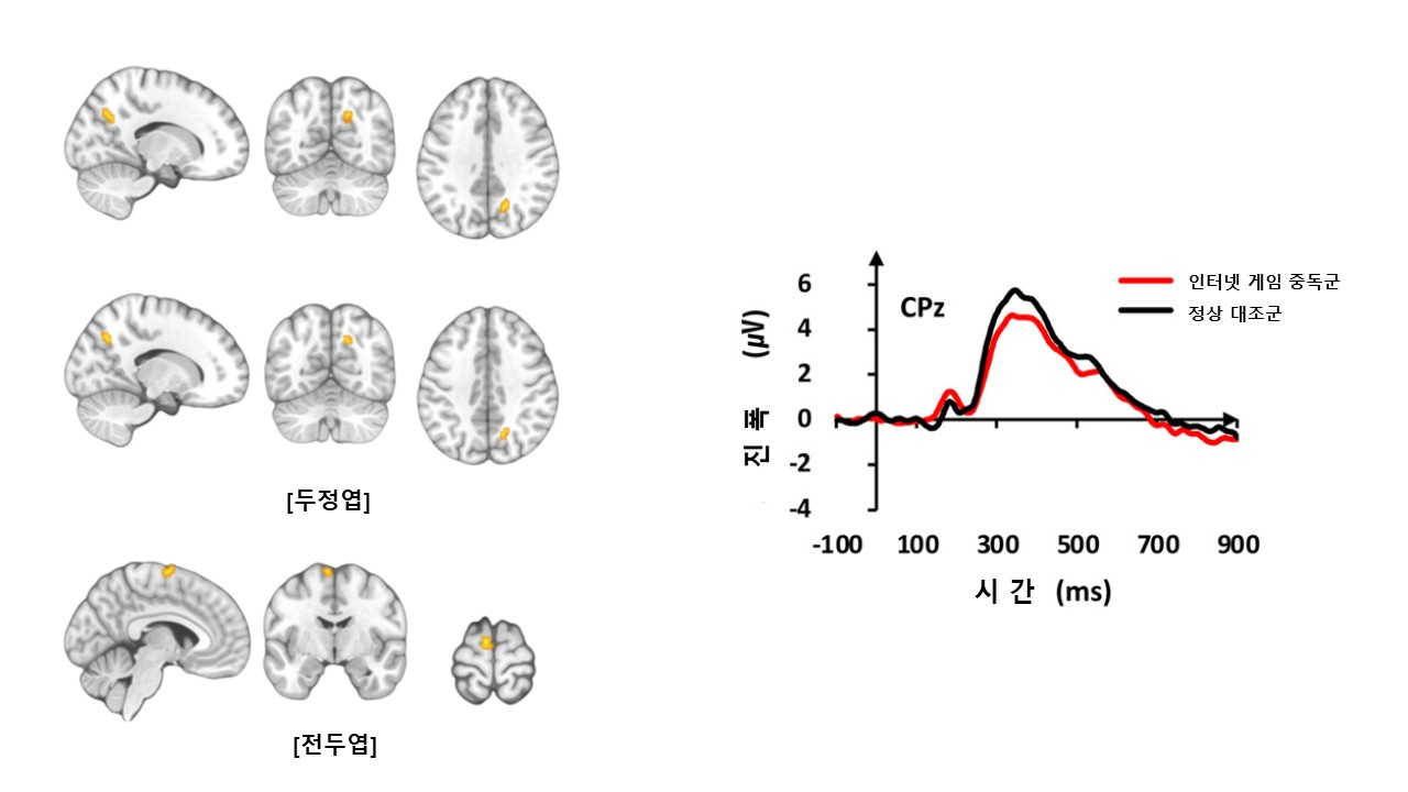 〈그림 1. 기능적 MRI 검사 결과 인터넷 게임 중독군은 정상대조군들보다 두정엽과 전두엽 부위에서 뇌 활성이 증가했다(좌측 사진). 청각 자극에 대한 뇌파 신호의 진폭은 인터넷 게임 중독군이 정상대조군보다 감소했다(우측 그래프).