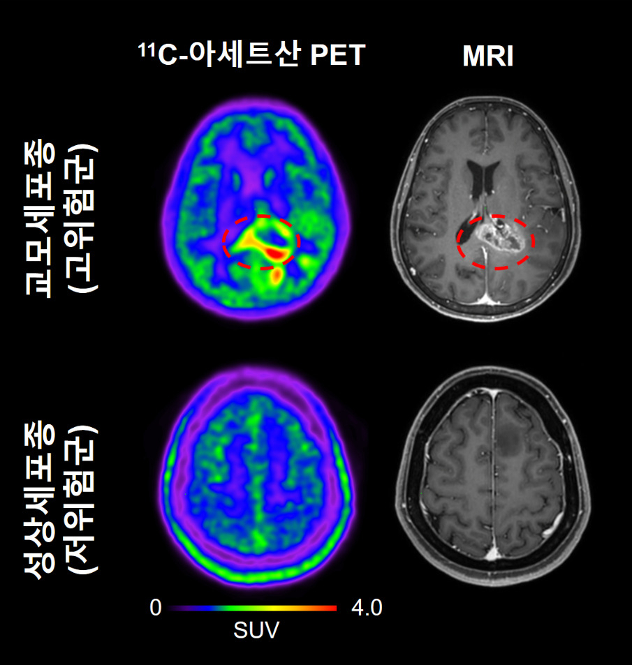 교모세포종(고위험군) 환자와 성상세포종(저위험군) 환자에서 관찰되는 11C-아세트산 PET와 MRI 이미지.[IBS 제공]