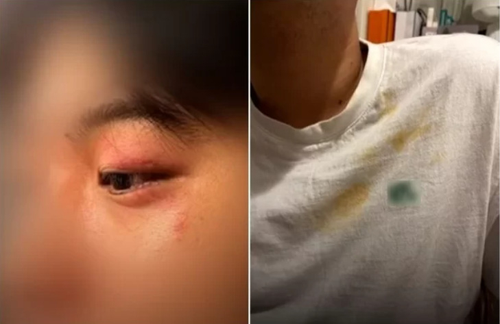 이탈리아 밀라노 여행 중 현지 괴한들로부터 인종 차별 발언과 폭행을 당하고 금품까지 뺏긴 20대 남성의 피해 모습. [JTBC 갈무리]