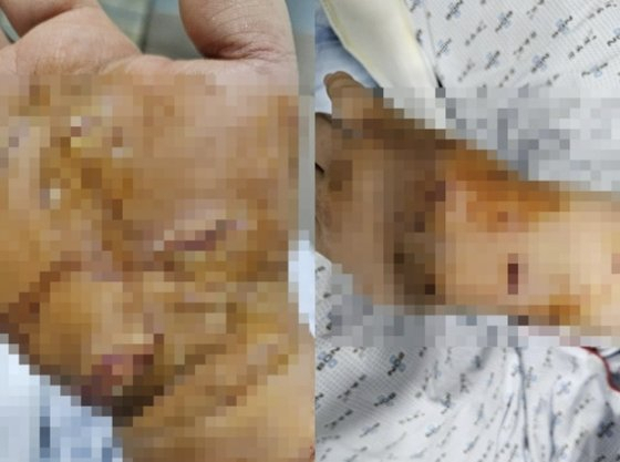 개 물림 사고를 당한 대리기사. [보배드림]